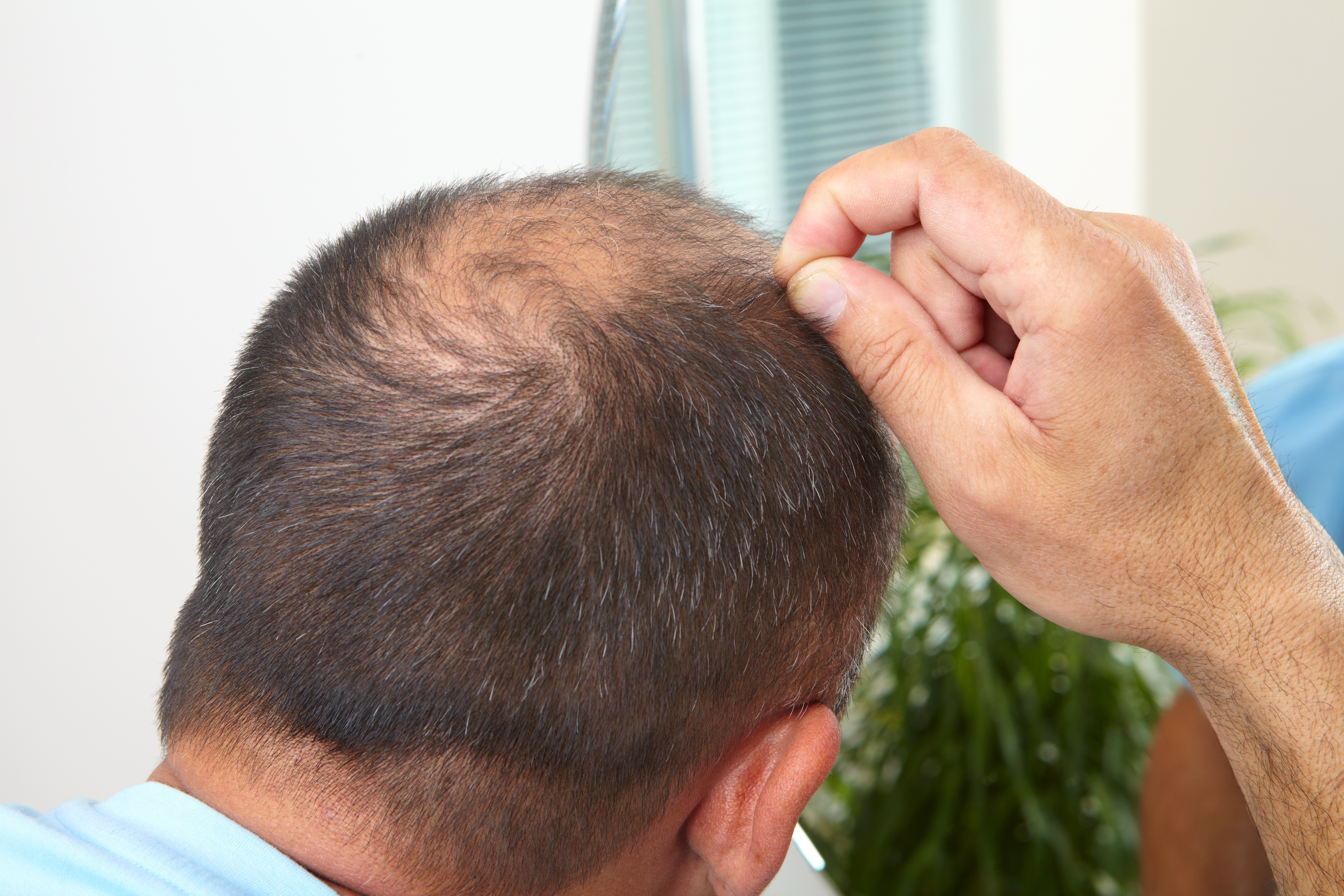 Hair Transplants: Do They Really Improve Health?